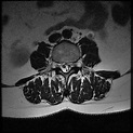 Arachnoiditis | Radiology Reference Article | Radiopaedia.org