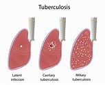 Facts About Tuberculosis: Symptoms, Vaccine, and Treatment. - Urgent ...