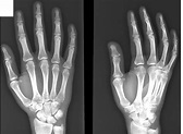 Hand x-ray. Causes, symptoms, treatment Hand x-ray