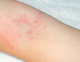 Rash 22 Common Skin Rashes Pictures Causes Treatment - vrogue.co