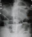 Bowel obstruction - Wikipedia