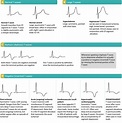 The T-wave: physiology, variants and ECG features – EKG & ECHO