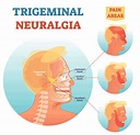 Trigeminal Neuralgia | Johns Hopkins Medicine