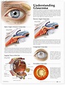 Health Blog — Understanding Glaucoma Chart