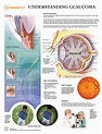 Understanding Glaucoma Chart | Eye Disorder Poster | Opthamology