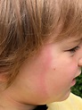 lyme disease rash. photo by Guswen Wikimedia Commons - Earth Buddies