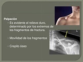 Fractura de clavicula