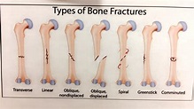 Types of Bone Fractures guide : r/coolguides