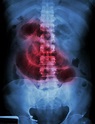 Bowel Obstruction | Intestinal Obstruction | MedlinePlus