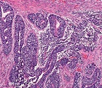 Pathology Outlines - Pulmonary blastoma
