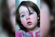 Scarlet Fever In Children: Symptoms, Causes, And Treatment ...