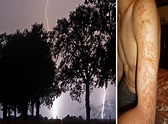 What it's like to be struck by lightning (and survive) | The ...