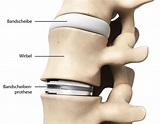 Bandscheibenprothese » Gründe, Funktionsweise & OP-Ablauf