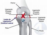 O que é a Lesão do Ligamento Colateral Lateral - LCL | Especialista do ...