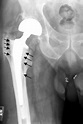Hip replacement - Wikipedia