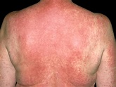 How Long Does A Drug Reaction Rash Last | Allergy Differences