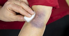 Bruise: Types, Symptoms, Causes, Prevention & Treatment