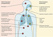 Acute respiratory distress syndrome: causes, pathophysiology, and ...