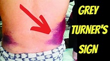 Grey Turner's Sign & Retroperitoneal Haemorrhage Explained | Doctor O ...