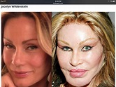 Pin by happygal831 on BEFORE. &. AFTER | Bad celebrity plastic surgery ...