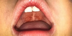 7 things every parent needs to know about Strep A infection - Which? News