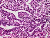 Pulmonary blastoma Case 162 | Pulmonary blastoma is a biphas… | Flickr