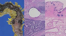 Pathology of Gangrene | IntechOpen