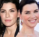 Julianna Margulies Plastic Surgery Before And After Face Photos
