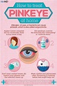 How to Get Rid of Pinkeye | Pink eyes, Eye facts, Optometry education