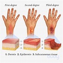 The 3 Types Of Burns – First Degree, Second Degree, Third Degree ...