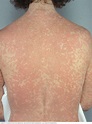 Drug rash - Mayo Clinic