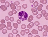 High Eosinophils and Certain Types of Cancer