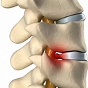 腰椎間盤突出症（常見的腰椎疾患）_百度百科