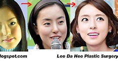 Plastic Surgery Examples: Lee Da Hee before & after / 이다희 성형 수술