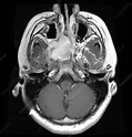 Juvenile Nasopharyngeal Angiofibroma, MRI - Stock Image - C027/1821 ...