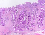 Adenocarcinoma Colon Histology