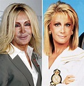 Joan Van Ark Plastic Surgery Before and After Rhinoplasty and Cheek ...