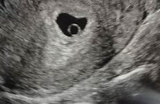 ultrasound pregnancy forums picturemeta