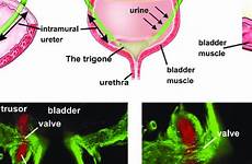 bladder trigone ureteral ureter insertion bud mackie stephens mendelsohn cathy