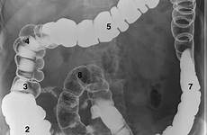 abdominal barium colon swallow axr emphasized