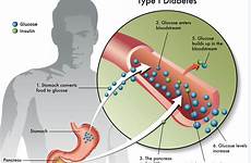 diabetes type pathophysiology happens which ucsf edu