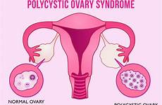 polycystic ovaries ovary right left follicles cysts everything need know cycle regular while shows has