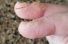 arthritis psoriatic fingers splitting thumb struggle personal conditions