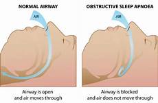 sleep apnoea obstructive syndrome osa cpap diagram nz courtesy illustration night