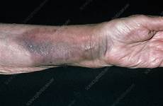 broken wrist arm bruising fractured radius due nhs surgery woman hand swelling symptoms