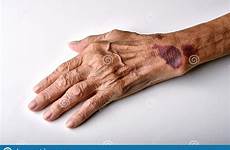 skin arm bruise wrist wound injury people accident subcutaneous elderly bruises senior old falls man stock abuse healing june posted