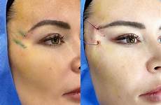 foxy threadlift brow lift puckering filler lifts clinic dermal fillers immediately themanseclinic