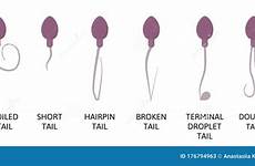 sperm abnormal semen defects parameters spermatozoon hairpin coiled