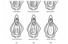 hymen imene anatomia tipi conformazione anatomical hymenal