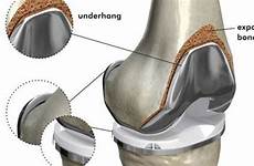 implants implant prosthesis